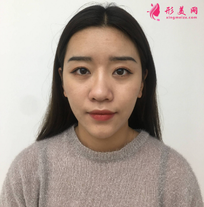 武漢德美余萌隆鼻術