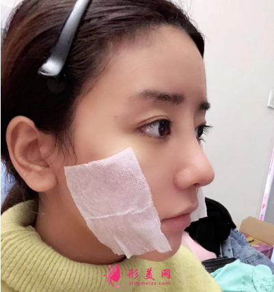 武漢德美余萌隆鼻術