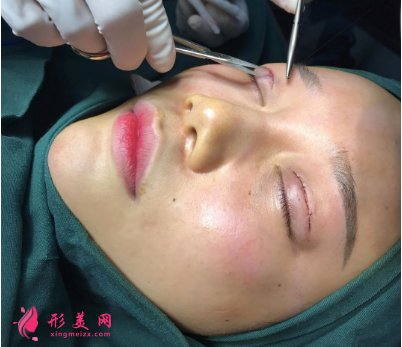 武漢德美劉小偉雙眼皮