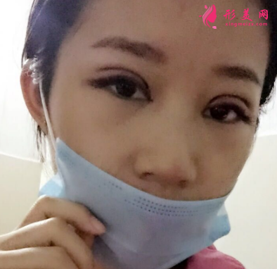 武漢德美劉小偉雙眼皮