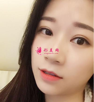 武漢德美劉小偉雙眼皮