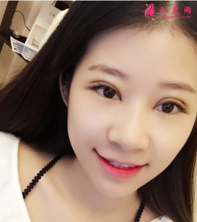 武漢德美劉小偉雙眼皮