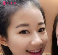 武漢德美整形醫(yī)院做的雙眼皮，感覺(jué)像換了個(gè)人一樣哈哈
