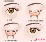手術(shù)祛眼袋可以維持多久？