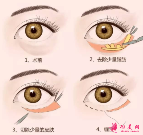 手術(shù)祛眼袋會不會有后遺癥