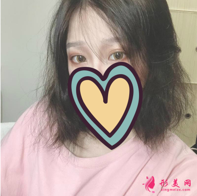 湖北省中醫(yī)院整形科胡霜紅雙眼皮