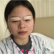 湖北省中醫(yī)院整形科做的雙眼皮，就算素顏出門也很美!