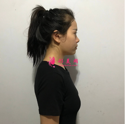 武漢一美彭義坤假體隆胸