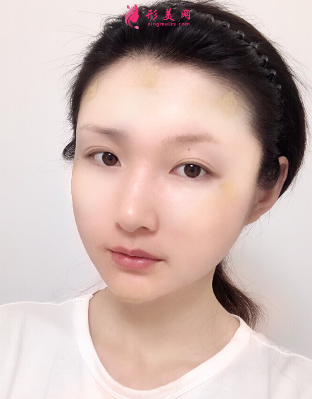 成都銅雀臺(tái)做自體脂肪面部填充多少錢？?jī)r(jià)格表？有沒有失敗案例