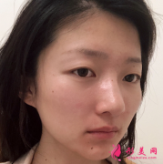 在成都美萊整形醫(yī)院做的自體脂肪填充，三個(gè)月啦臉部圓潤(rùn)了不少