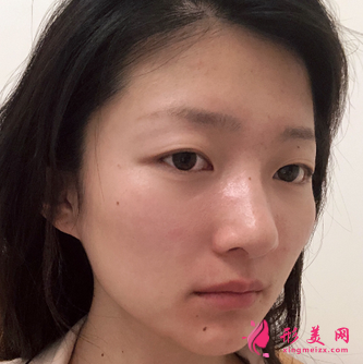 成都銅雀臺(tái)和華美相比做自體脂肪面部填充哪個(gè)醫(yī)生好？多少錢