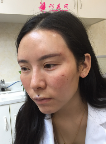 成都軍大整形醫(yī)院自體脂肪填充案例 成都軍大整形醫(yī)院自體脂肪填充案例