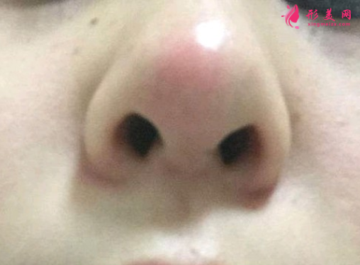 假體隆鼻失敗修復(fù)的費(fèi)用是多少