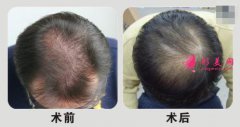 杭州植發(fā)醫(yī)院哪家好？如何挑選正規(guī)的醫(yī)院？植發(fā)前后對(duì)比圖