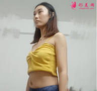 重慶美圣美邦整形醫(yī)院做腰腹吸脂，還你一個(gè)迷人小蠻腰哦~