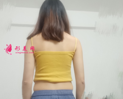 重慶美圣美邦整形醫(yī)院任志偉腰腹吸脂