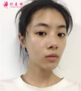 武漢藝星楊斐醫(yī)生給我做的鼻綜合，拯救了我的塌鼻子