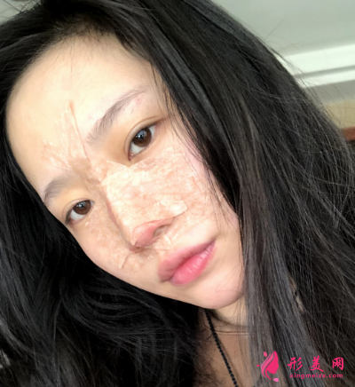 成都正好整形醫(yī)院劉志春做隆鼻手術(shù)