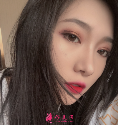 成都正好整形醫(yī)院劉志春做隆鼻手術(shù)