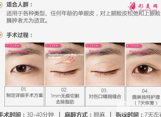 北京割雙眼皮多少錢