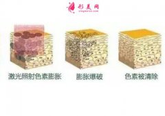 去除臉上黃褐斑有哪些方法？效果好嗎？