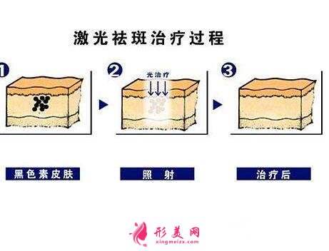 去除臉上黃褐斑