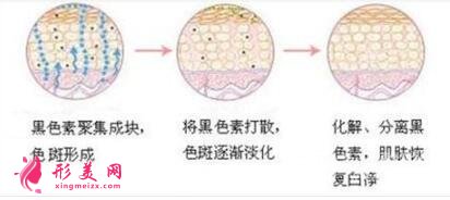 去除臉上黃褐斑有哪些方法？效果好嗎？