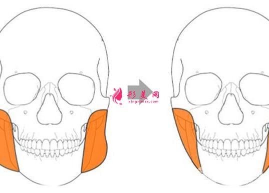 咬肌切除手術(shù)風(fēng)險(xiǎn)大么