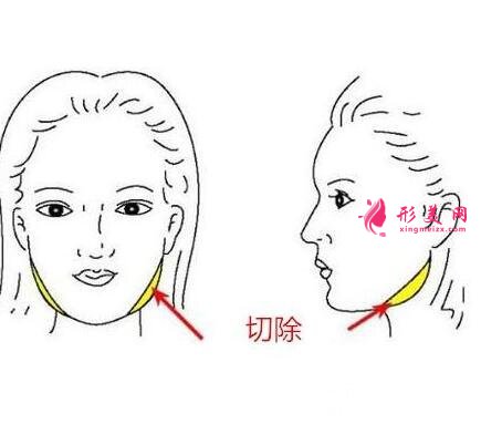 咬肌切除手術(shù)風(fēng)險(xiǎn)大么