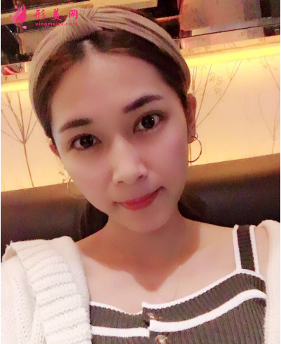 武漢韓辰整形醫(yī)院李相奇雙眼皮案例