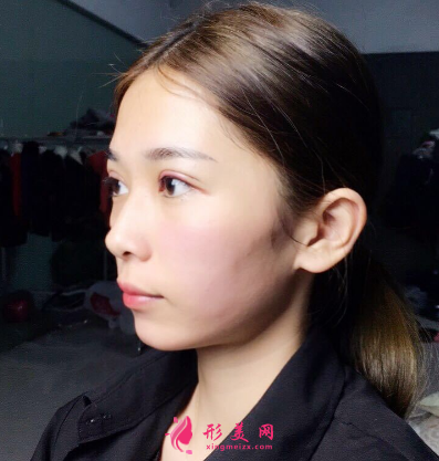 武漢韓辰整形醫(yī)院李相奇雙眼皮案例