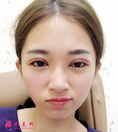 武漢韓辰整形醫(yī)院李相奇雙眼皮案例