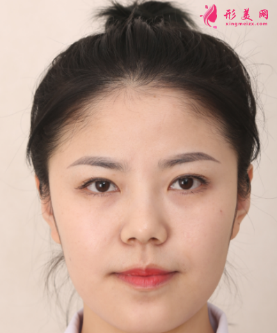 武漢韓辰整形醫(yī)院樊輝華面部吸脂