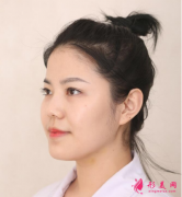武漢美基元醫(yī)療美容醫(yī)院做的面部吸脂，終于跟肉肉的臉說拜拜了