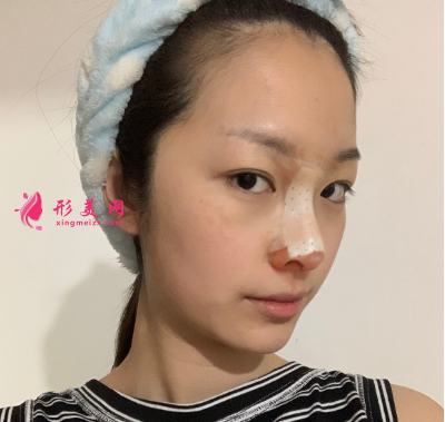 武漢韓辰整形醫(yī)院牛永敢隆鼻技術(shù)