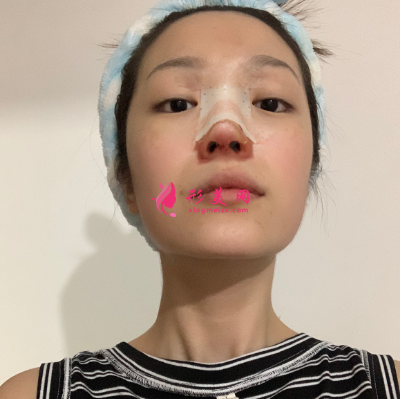 武漢韓辰整形醫(yī)院牛永敢隆鼻技術(shù)