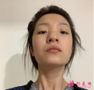 武漢卓美整形醫(yī)院隆鼻技術(shù)怎么樣?翹麗的鼻子看起來超自然