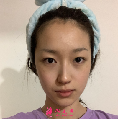 武漢韓辰整形醫(yī)院牛永敢隆鼻技術(shù)