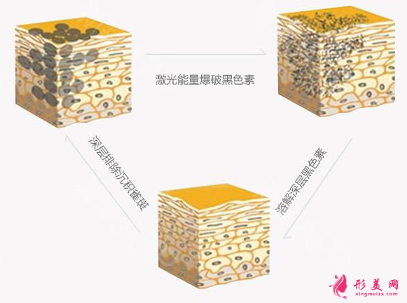 激光祛斑對皮膚有創(chuàng)傷嗎