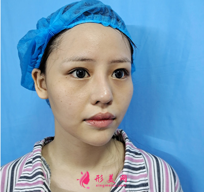 成都美雅娜整形醫(yī)院廖連平假體隆鼻