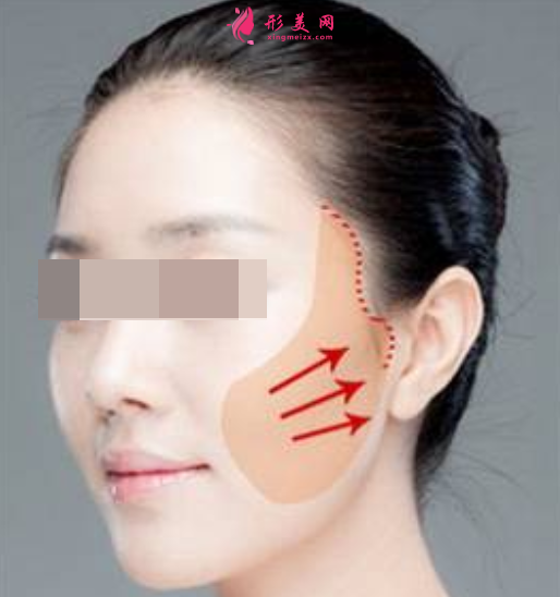 面部埋線提升腫脹期多久