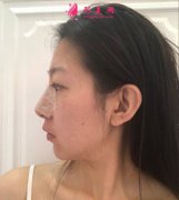 大家?guī)臀铱纯瓷虾Ｃ廊R整形醫(yī)院做的肋軟骨隆鼻，術(shù)后60天效果如何