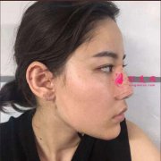 找上海美萊整形醫(yī)院做的鼻綜合，鼻子越來越好看了