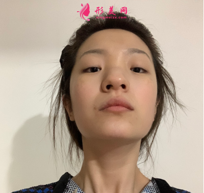 武漢韓辰整形醫(yī)院牛永敢隆鼻技術(shù)