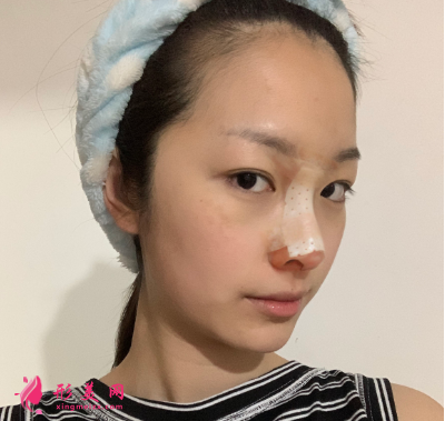 武漢韓辰整形醫(yī)院牛永敢隆鼻技術(shù)
