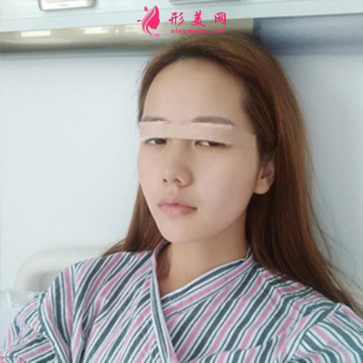 上海東方麗人整形醫(yī)院吳建明雙眼皮案例
