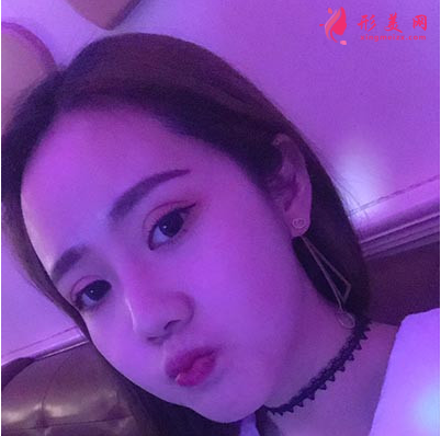 上海東方麗人整形醫(yī)院吳建明雙眼皮案例
