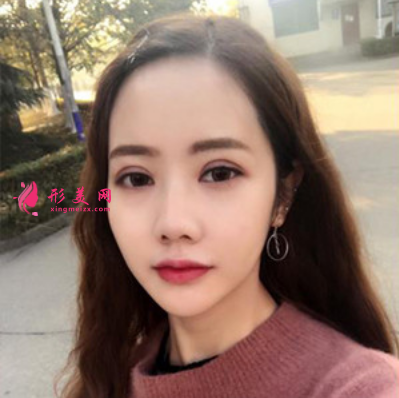 上海東方麗人整形醫(yī)院吳建明雙眼皮案例