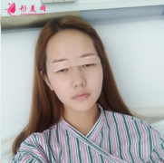 上海東方麗人吳建明為我做的雙眼皮，真是越好看越自信