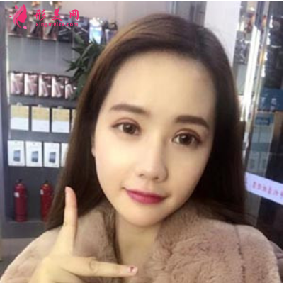 上海東方麗人整形醫(yī)院吳建明雙眼皮案例